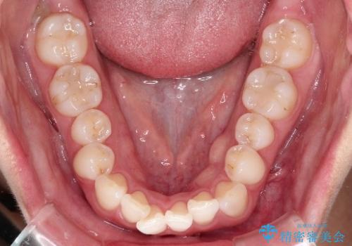 【前歯のガタガタが気になる】インビザライン症例の治療前