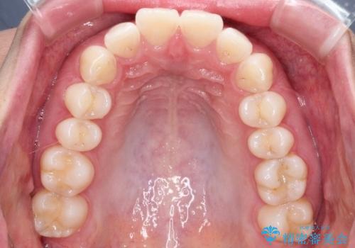 【前歯のガタガタが気になる】インビザライン症例の治療前