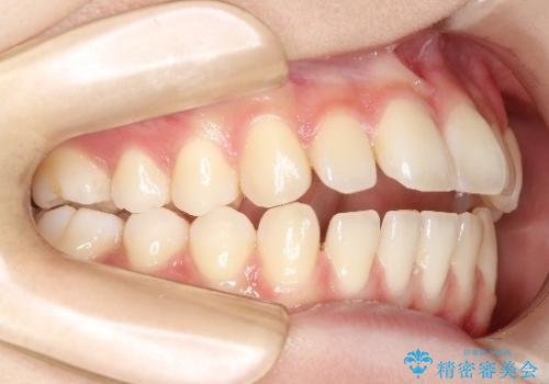 【前歯で噛めません、すきっ歯も気になります】インビザライン治療症例の治療前