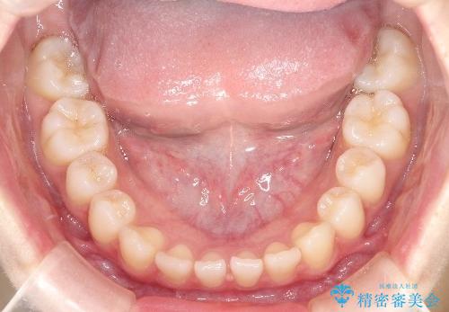 【前歯で噛めません、すきっ歯も気になります】インビザライン治療症例の治療前