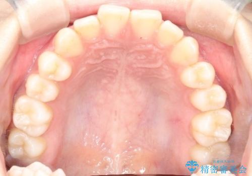 【前歯で噛めません、すきっ歯も気になります】インビザライン治療症例の治療前