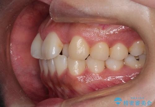 【引っ込んだ前歯が気になる、真ん中の線も揃えたい】インビザライン症例の治療前