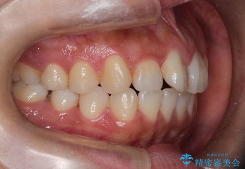 【引っ込んだ前歯が気になる、真ん中の線も揃えたい】インビザライン症例の治療前