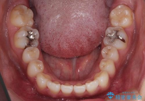 【引っ込んだ前歯が気になる、真ん中の線も揃えたい】インビザライン症例の治療前