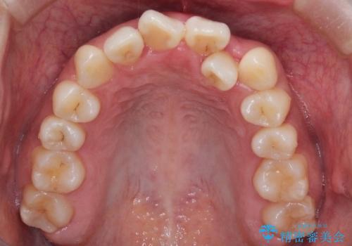 【引っ込んだ前歯が気になる、真ん中の線も揃えたい】インビザライン症例の治療前