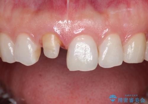 【オールセラミッククラウン】他院で入れた被せものがすぐとれるの治療中