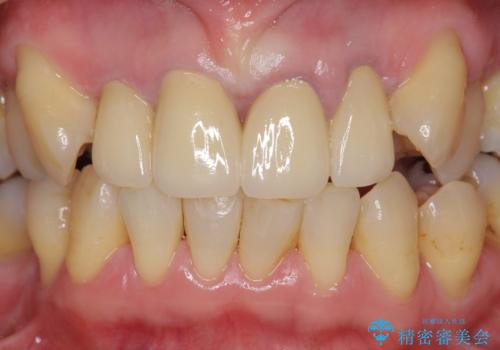 前歯をきれいにしたいの治療後