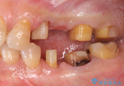 古くなった銀歯をやりかえたいの治療中