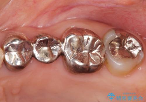 古くなった銀歯をやりかえたいの治療前
