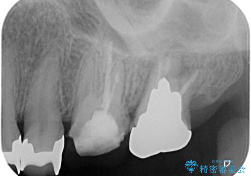 【根管治療】未処置根管を有した歯の再根管治療の治療前