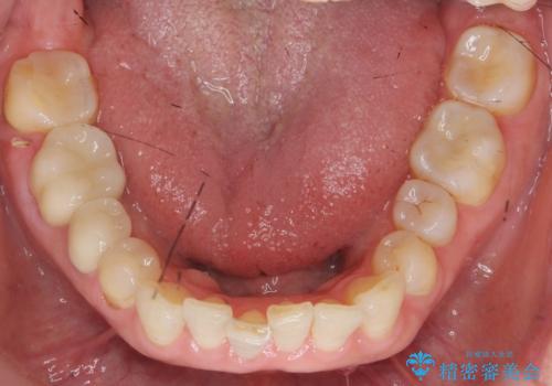 口腔内をメタルフリーにしたいの治療後