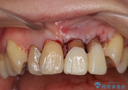 前歯をきれいにしたいの治療中