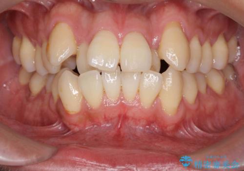 [ 成人矯正 ] 目立つ八重歯を治したいの症例 治療前