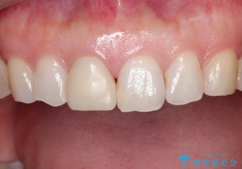 【オールセラミッククラウン】他院で入れた被せものがすぐとれるの治療前