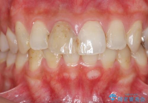 前歯をきれいにしたいの治療前