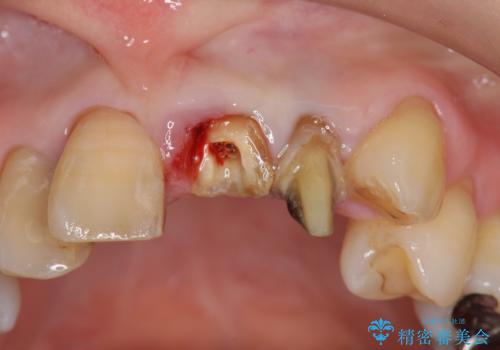 前歯をきれいにしたいの治療中