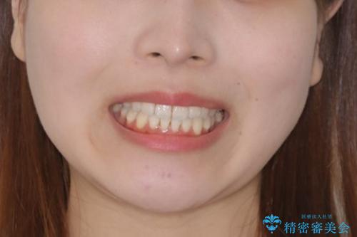前歯で噛めない:オープンバイト(開咬)を非抜歯インビザラインで治療の治療後（顔貌）