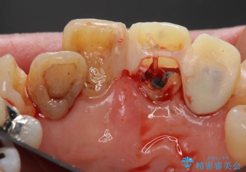 前歯をきれいにしたいの治療中
