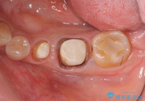 古くなった銀歯をやりかえたいの治療中