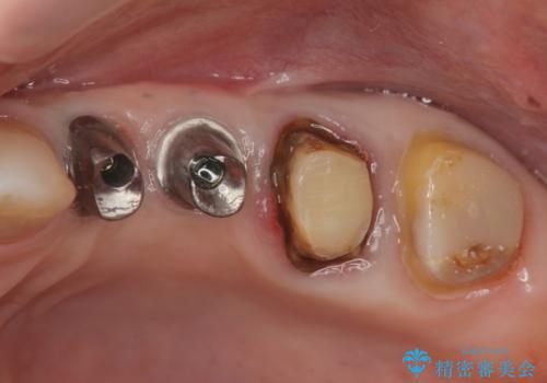 銀歯や古くなったクラウンをやりかえたいの治療中