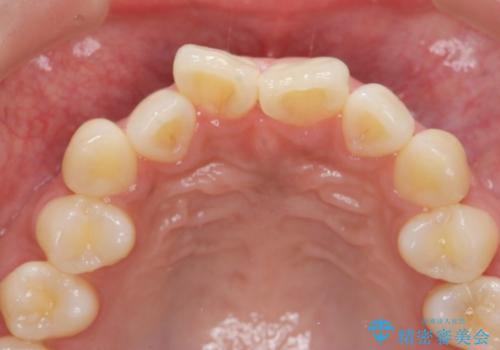 [ 前歯のセラミック治療 ]   短期間で歯並びを治したいの治療前