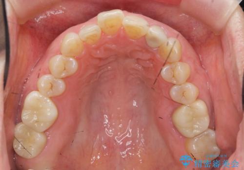 口腔内をメタルフリーにしたいの治療後