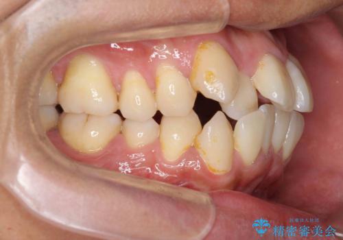 [ 成人矯正 ] 目立つ八重歯を治したいの治療前