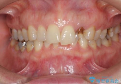 口腔内をメタルフリーにしたいの治療前