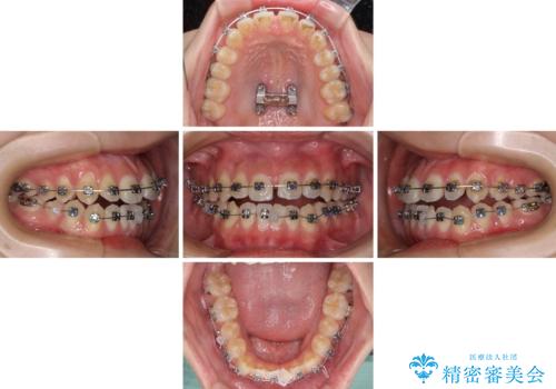 受け口と開咬を急速拡大装置とワイヤー装置で改善の治療後