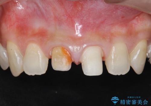 前歯をきれいにしたいの治療中