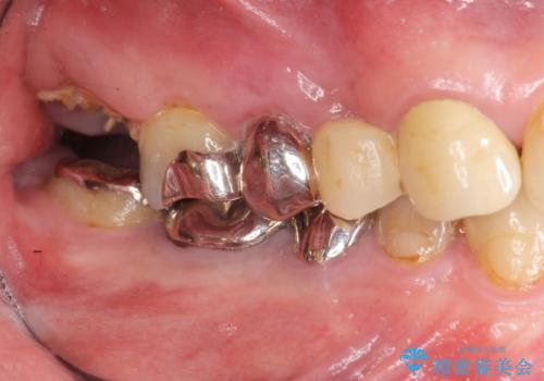 [ インプラントによる機能回復 ]     強い咬合力　放置した虫歯の治療の症例 治療前