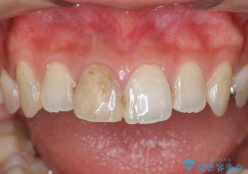 前歯をきれいにしたいの治療前