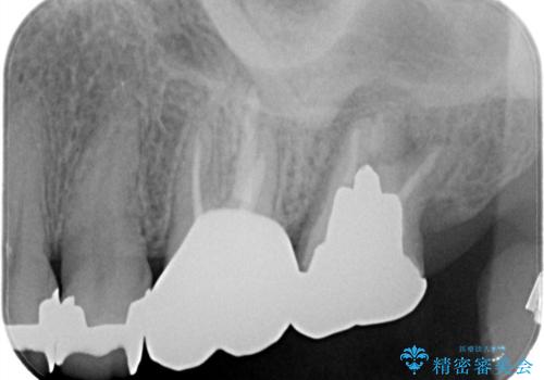 【根管治療】未処置根管を有した歯の再根管治療の治療後