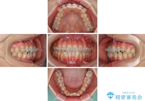 前歯のクロスバイト ワイヤー装置を併用したインビザライン矯正の治療中