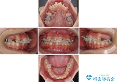 【モニター】八重歯とデコボコをスッキリきれいに ワイヤー装置での抜歯矯正の治療中