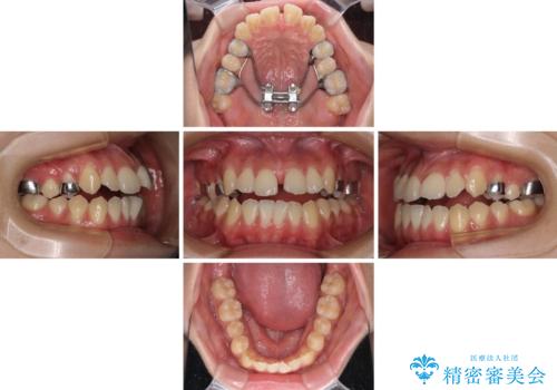 受け口と開咬を急速拡大装置とワイヤー装置で改善の治療前