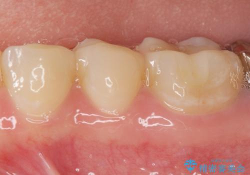 目立つ銀歯を白くしたいの治療後