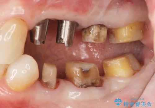 銀歯や古くなったクラウンをやりかえたいの治療中