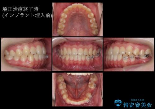 生まれつき歯が少ない 20代でインプラント治療の治療中