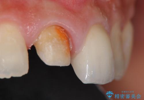 前歯をきれいにしたいの治療中