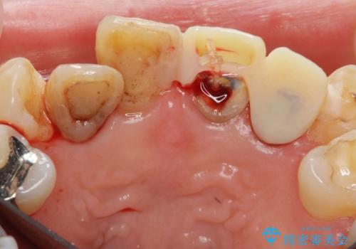 前歯をきれいにしたいの治療中