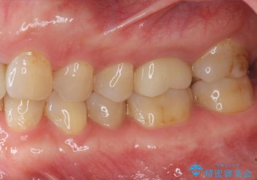 口腔内をメタルフリーにしたいの治療後