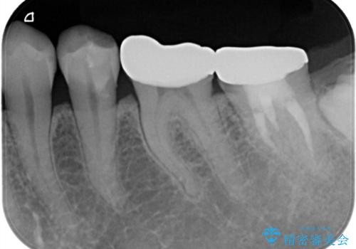 他院で仮歯までしたが、放置していたためセラミック入れたい セラミック治療の治療後