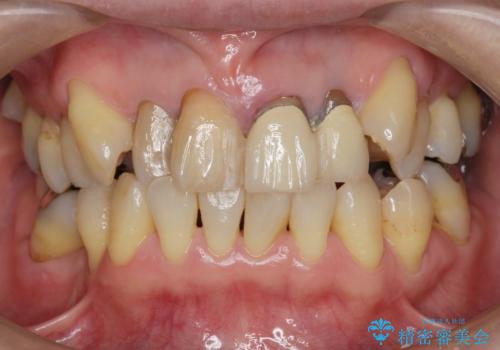 前歯をきれいにしたいの治療前