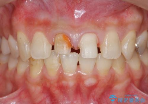 前歯をきれいにしたいの治療中