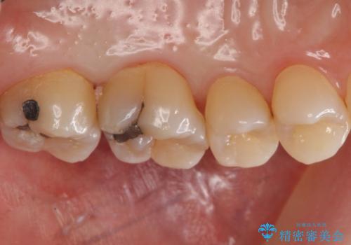 奥歯の虫歯 セラミックインレーによる治療の治療前