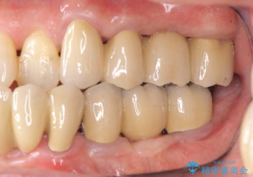 インプラント治療を併用した全顎歯周病治療の治療後