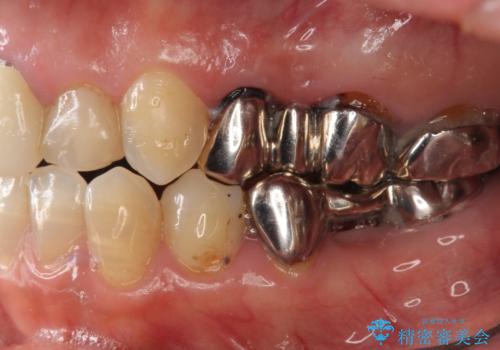 銀歯を白くしたい セラミックブリッジでの治療の治療前