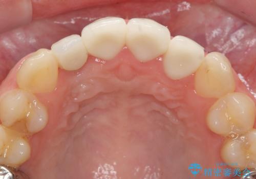 前歯の虫歯 オールセラミック治療の治療後