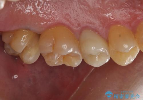 放置していた虫歯 セラミックインレーによる治療の治療中